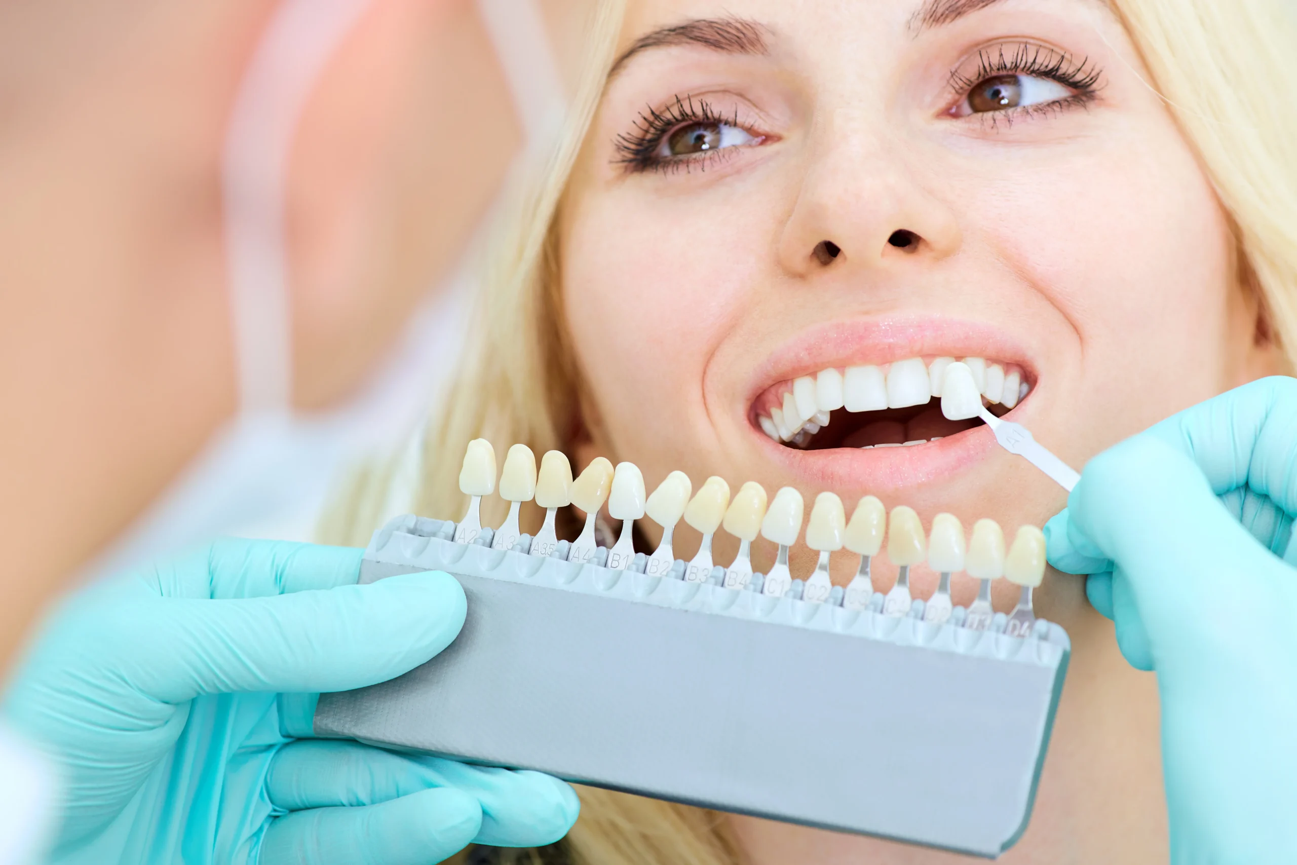 Are Teeth Whiteners Safe and Worth Trying